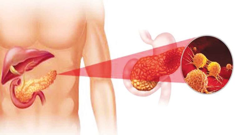 Breakthrough in Pancreatic Cancer Research: New Protein Target Offers Hope for Early Detection and Control